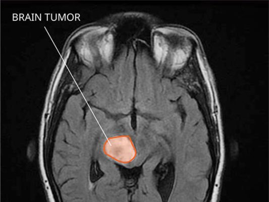 Glioma brain tumor surgery in Iran