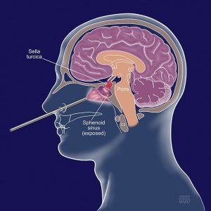 Endoscopic Pituitary Surgery in Iran