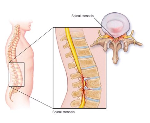 treatment Spinal stenosis in Iran