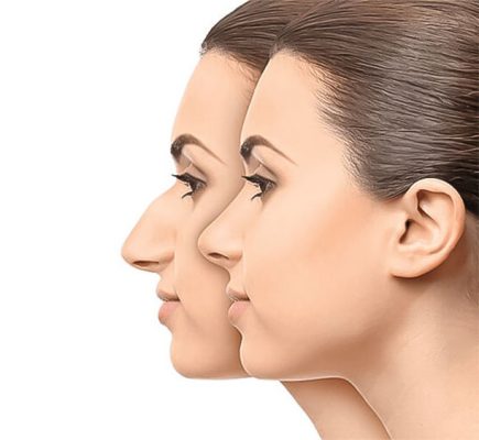 Pre- and post- rhinoplasty in Iran - 42 Tips