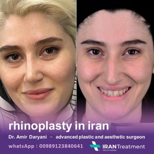 Rhinoplasty in iran - Dr. Amir Daryani
