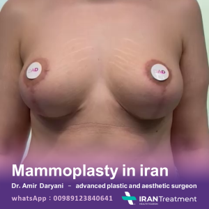 Mammoplasty in Iran