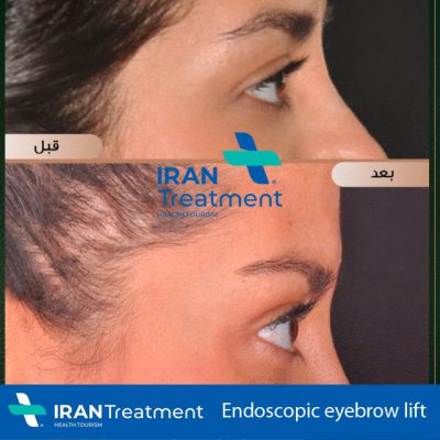 best eyebrow lift surgeon in Iran