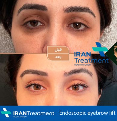 best eyebrow lift surgeon in Iran