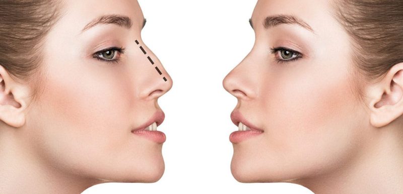 Top 5 Cheapest Countries for Rhinoplasty