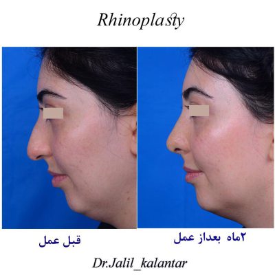 Best Rhinoplasty Surgeon in Iran - before - after