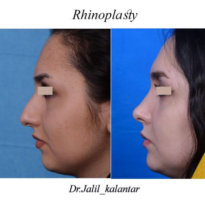 Best Rhinoplasty Surgeon in Iran - before - after
