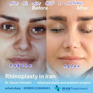 Rhinoplasty in Iran- Dr Shobeiri