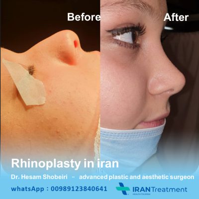 Rhinoplasty in Iran- Dr Shobeiri