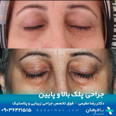 Eyelid surgery in Iran