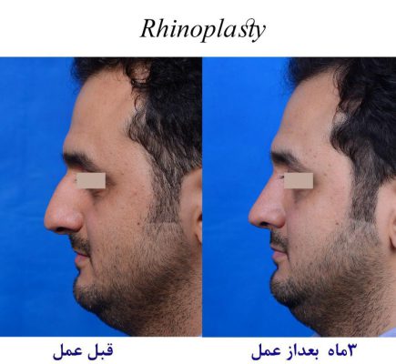 Best country for rhinoplasty
