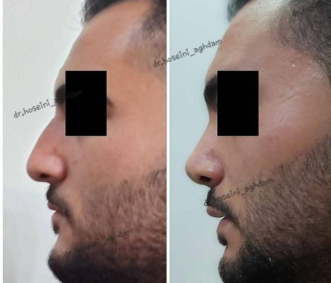 Best country for rhinoplasty