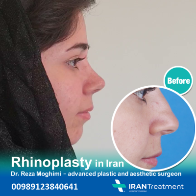 Dr reza Moghimi - Rhinoplasty in Iran