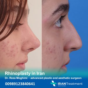 Rhinoplasty in Iran - Dr. Mohammad Reza Moghimi