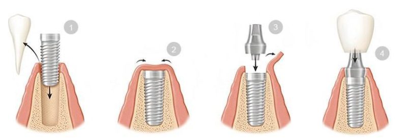 cheapest country to get dental implants