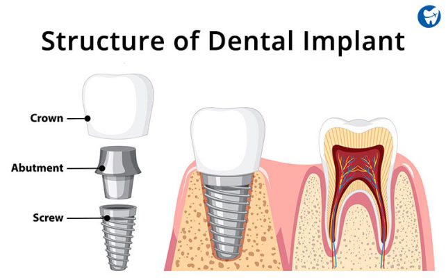 cheapest country to get dental implants