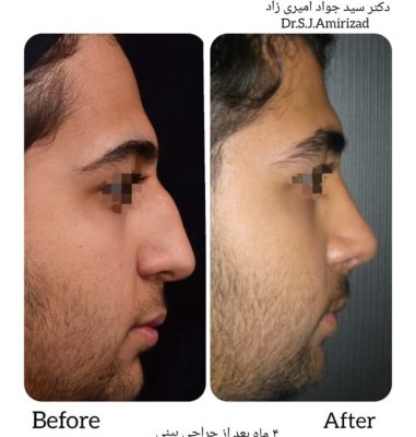 Dr. Amirizad – nose surgeon – plastic surgeon specialist