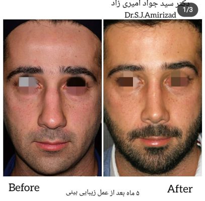 Dr. Amirizad – nose surgeon – plastic surgeon specialist