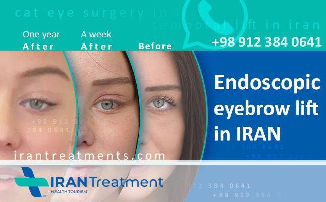 Foxy Eye - Cat eye surgery in Iran - ٍEndoscopic method