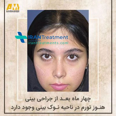 dr. Alireza Mohebbi - Rhinoplasty in Iran