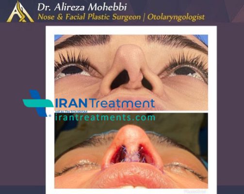 dr. Alireza Mohebbi - Rhinoplasty in Iran