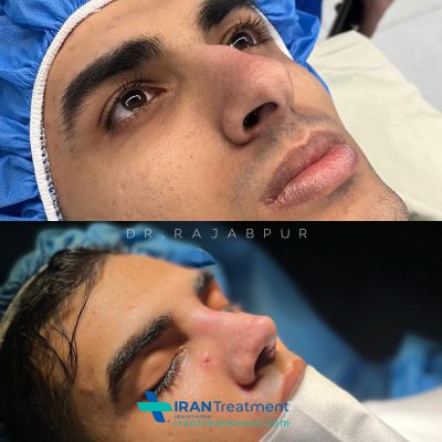 Nose Job in Iran - Rhinoplasty Dr . Rajabpour