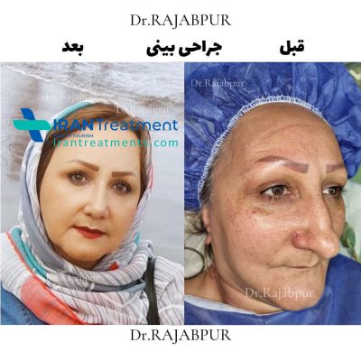 Nose Job in Iran - Rhinoplasty Dr . Rajabpour