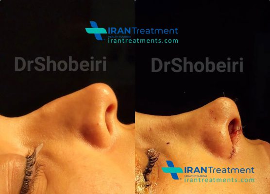 Dr. Shobeiri - nose surgeon - plastic surgeon specialist