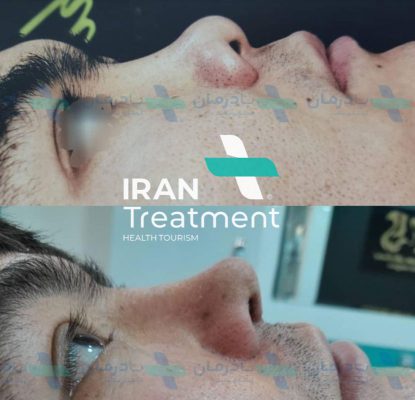 rhinoplasty Cost in Iran