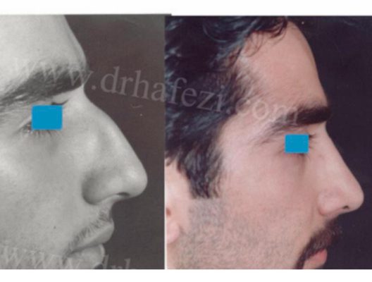 Dr. Haffezi - nose surgeon - plastic surgeon specialist
