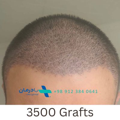 which country is cheapest for hair transplant