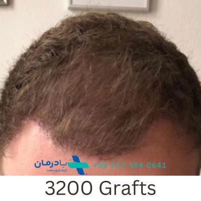 which country is cheapest for hair transplant