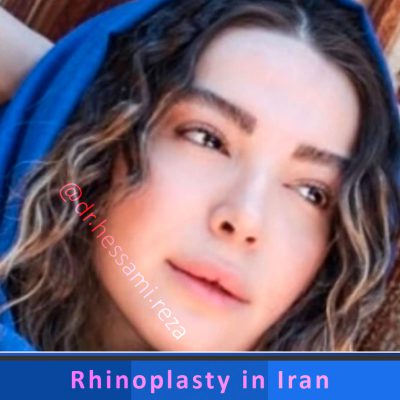 Dr. Hessami rhinoplasty in Iran