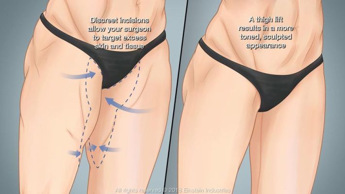 Liposuction and thigh lift in Iran - cost 2023