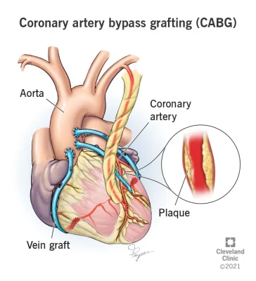 Coronary artery bypass surgery in Iran - (CABG)
