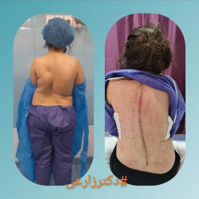specializing in spinal surgery in Iran