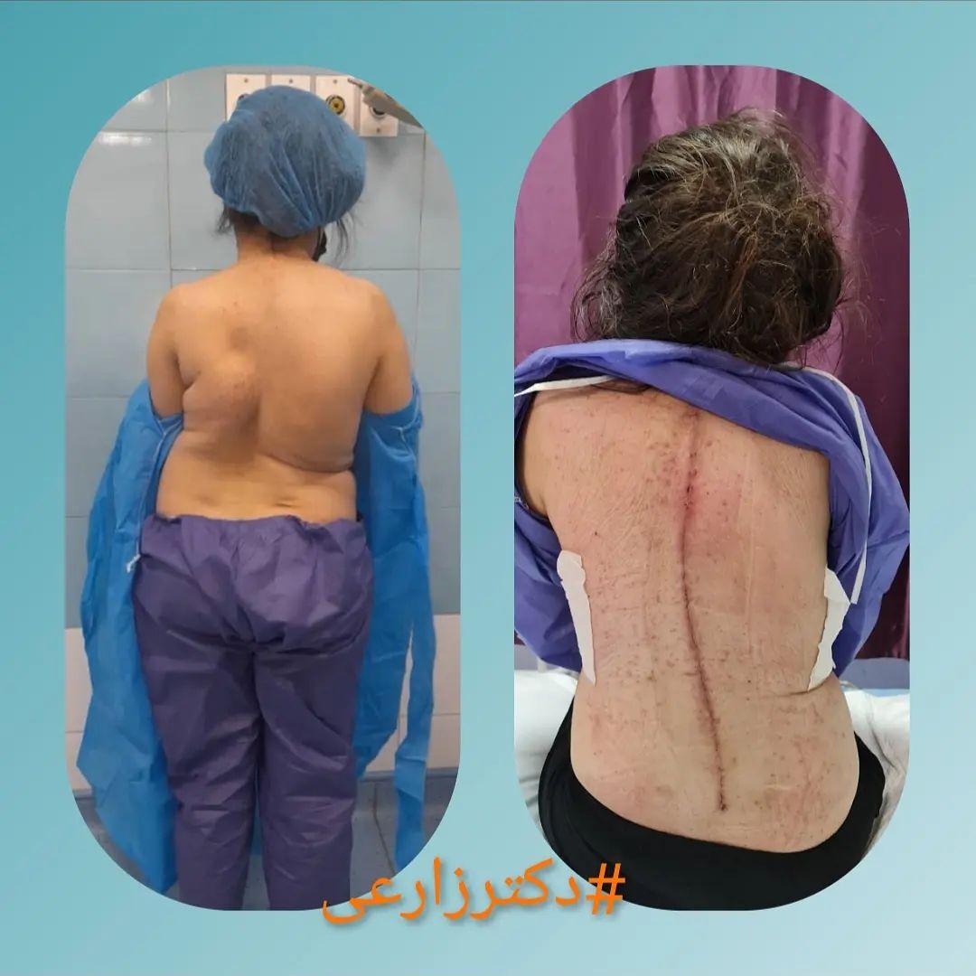 Scoliosis surgery in Iran - Dr. Mohammad Zarei