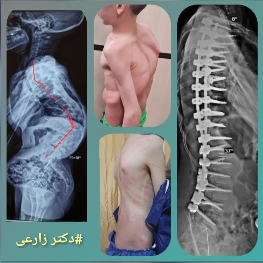 scoliosis surgery in Iran