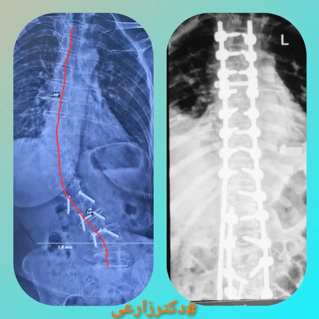 scoliosis surgery in Iran