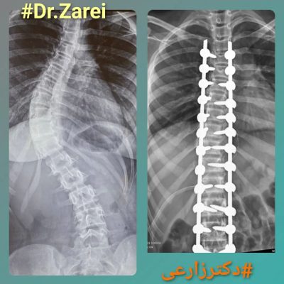 specializing in spinal surgery in Iran