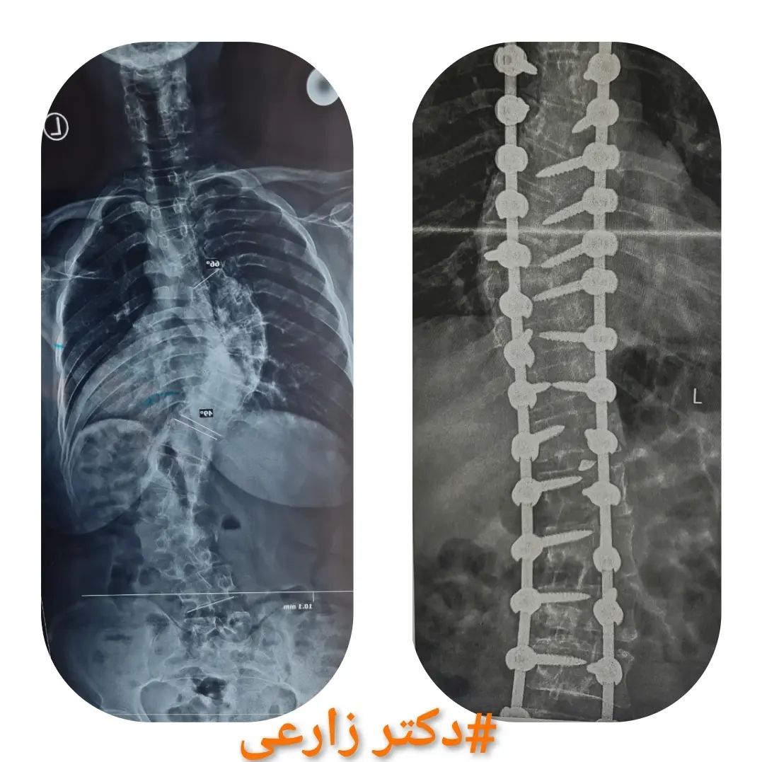 Scoliosis surgery in Iran - Dr. Mohammad Zarei