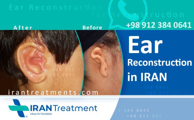 Ear Reconstruction in Iran