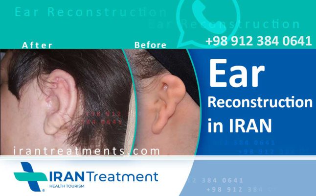Ear Reconstruction in Iran