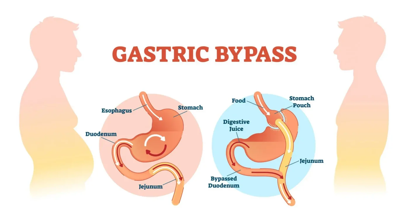 Gastric bypass in Iran