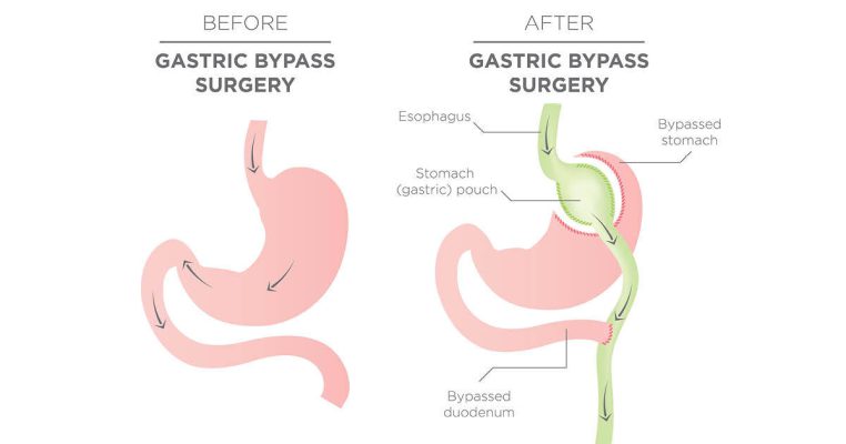 Gastric bypass in Iran