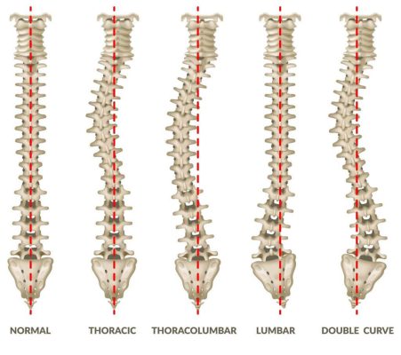 Different Types of Scoliosis - cheapest country for Scoliosis Surgery
