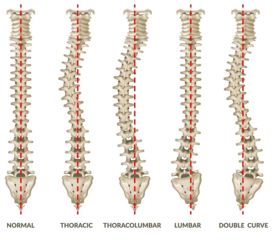 Different Types of Scoliosis