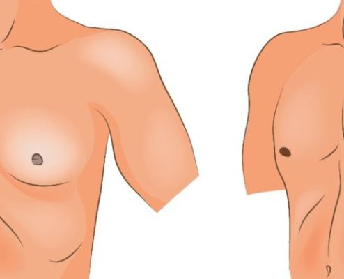 Gynecomastia in Iran - man boobs corrections