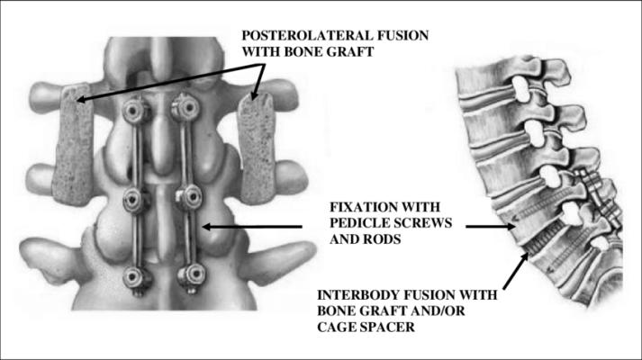 Spinal fusion in Iran