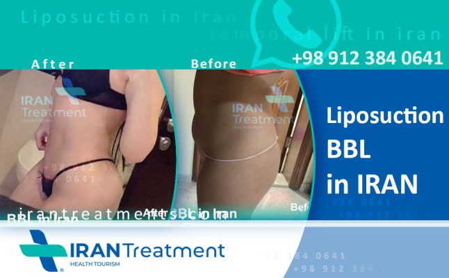 Liposuction in Iran - body contours